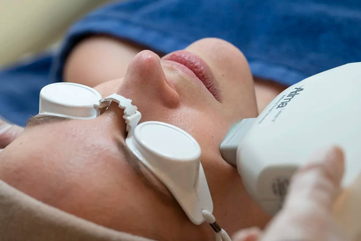 Photorajeunissement par lumière intense pulsée IPL à Paris