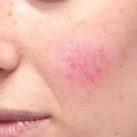 Soin visage peau sensible à Paris