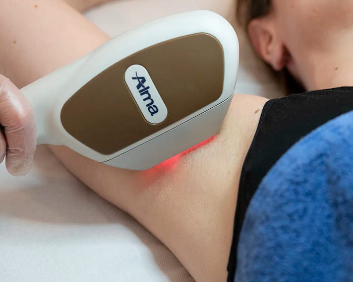 Épilation par Lumière Pulsée Intense IPL Alma Laser à Paris
