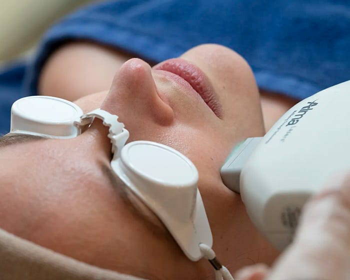 Photorajeunissement par lumière intense pulsée IPL à Paris